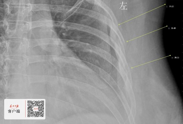 武汉30岁女白领咳断三根肋骨把咖啡当水最多一天喝10杯