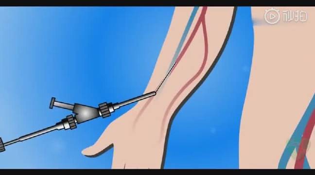 3d演示一分钟看懂心脏支架手术