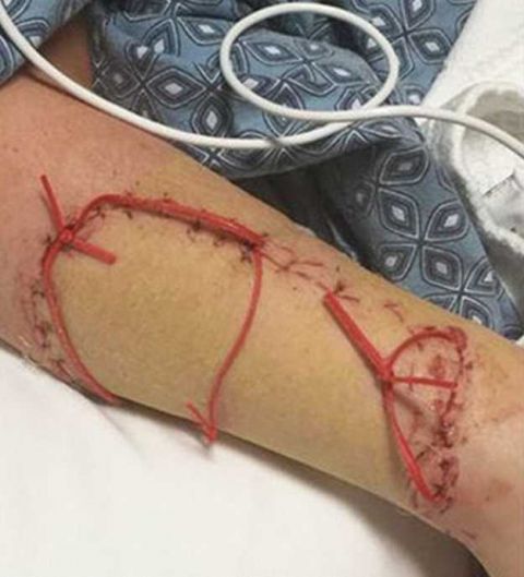 10岁男孩在海中与弟弟玩耍,右臂不慎被鲨鱼咬伤