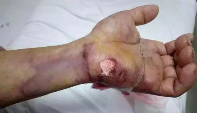 福州一男子被这种鱼刺伤住院12天难愈医生说严重会致命