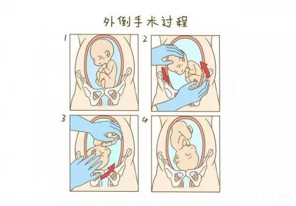 分娩交流:胎儿臀位该如何选择分娩方式?一定要剖腹产吗?