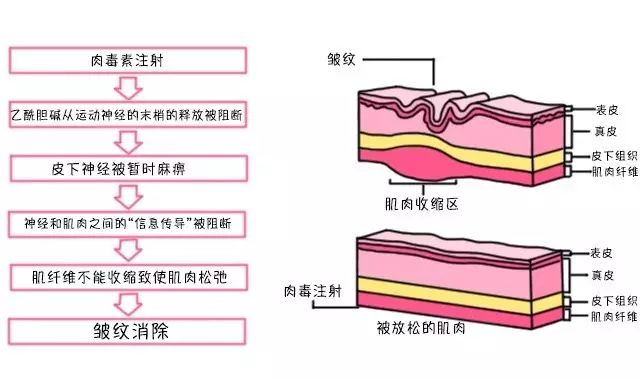 除皱针