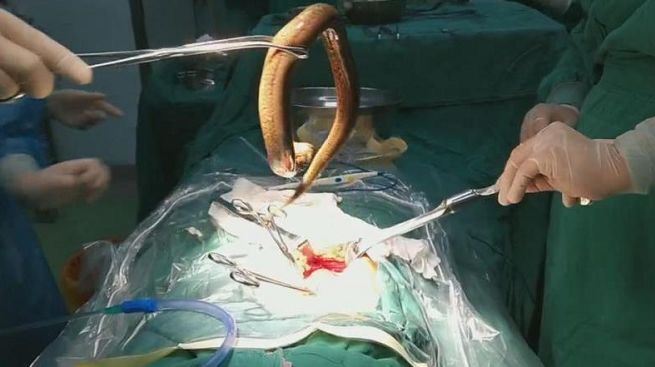 男子生吞30厘米黄鳝,钻进肠子!竟是因为.