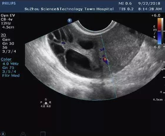 彩超查出卵巢多囊样改变是不是怀孕就困难了