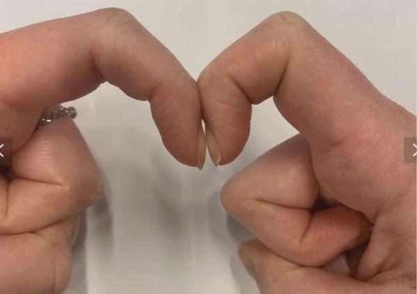 杵状指自检或可提示肺癌风险