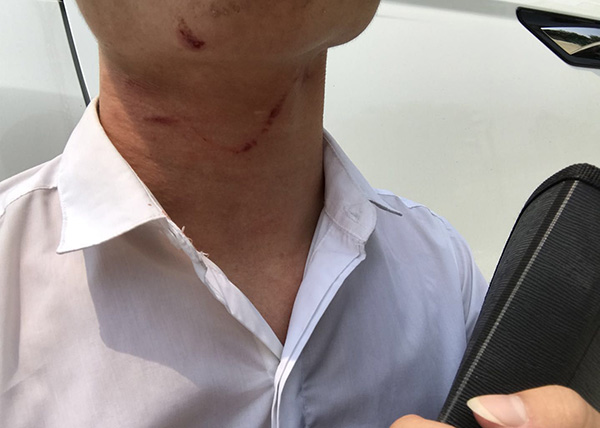 徐先生称脖子上的伤为掐痕.受访者供图
