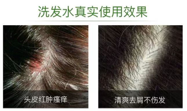 头皮痒的难受用这个迷迭香洗发水祛除头螨拯救油头持续清爽