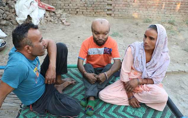 印度男子患怪病面部畸形 被嘲笑像外星人