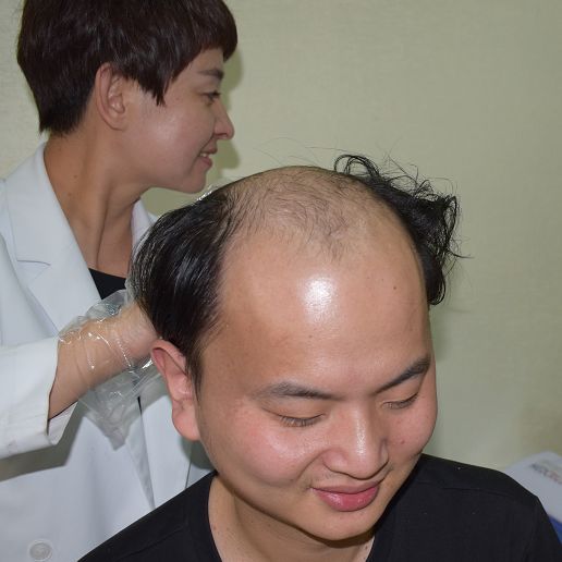 头发也可以种出来?遗传性脱发、秃顶、前额光
