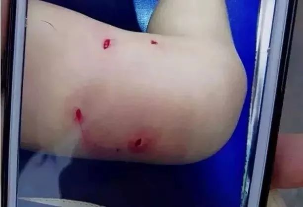 女婴路边晒太阳 突遭恶犬袭击整张脸被咬伤 女婴路边晒太阳 突遭恶犬袭击整张脸被咬伤