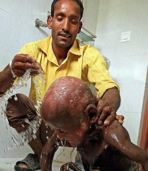 印度男孩患怪病即将变成石头全球得此病者不到十人