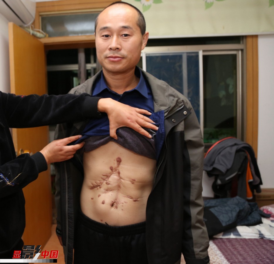 【显影中国】他切除6种内脏器官 依然选择坚守乡村讲台