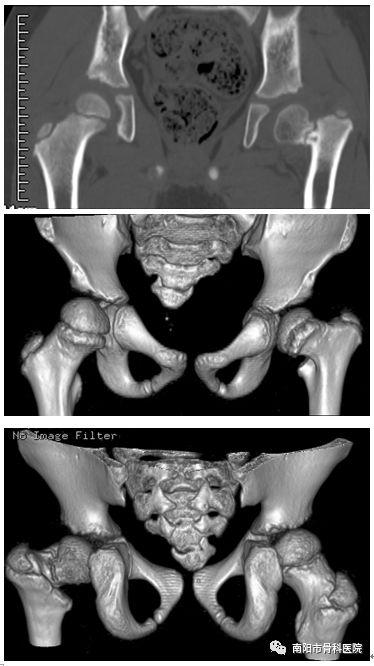 术前x光片可以明显看到左侧髋内翻畸形,股骨颈发育差 术后第3个月