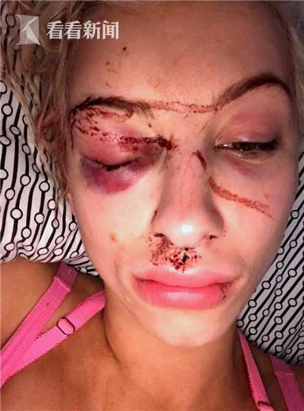 英国女模收好友劝分短信遭男友囚禁打瞎眼睛图