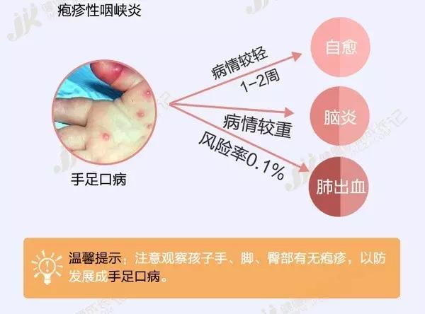 皰疹性咽峽炎迎來高發期 比手足口病還厲害