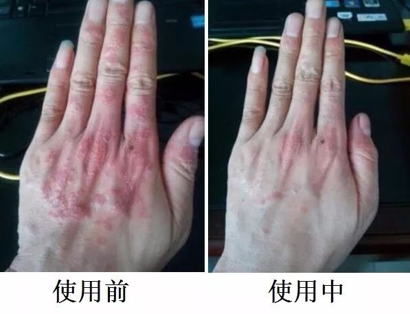 泰国进口万能膏,皮炎湿疹癣病,一抹见效!