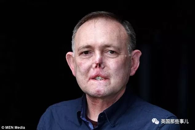 跟自家狗狗玩耍中被抓伤还被舔了下两周后他失去了