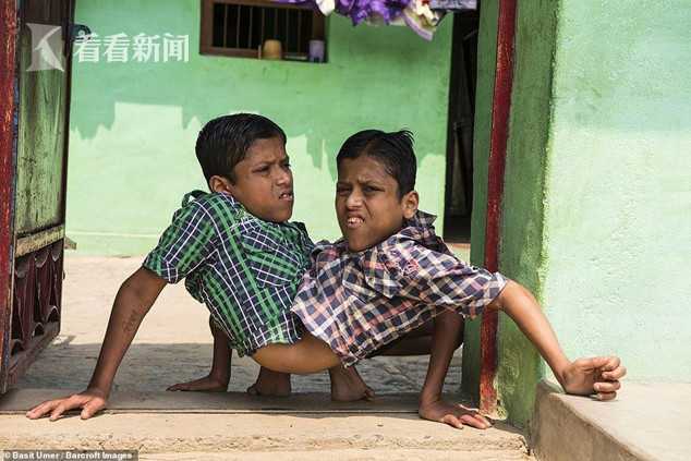 连体双胞胎兄弟18岁了共用腰部双腿无悔不分离