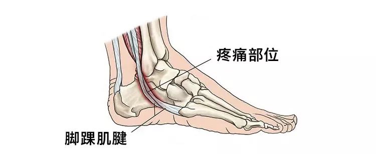 ▇ 踝关节下方外侧疼痛神经瘤的发作是由于前脚掌受到过度挤压,足底的