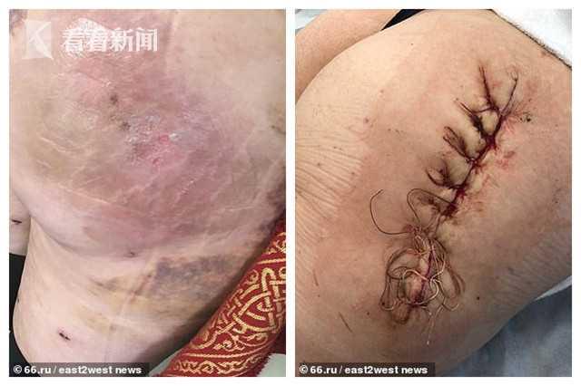 女子整形失败上门理论再遭忽悠 错上加错臀部留血洞坐下就疼