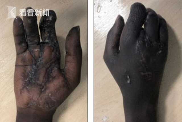 男子玩鞭炮来不及丢 手掌被炸两半 手指如外星人