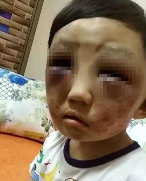 4岁小男孩离家出走:被90后离异母亲虐待的鼻青脸肿,浑身是伤