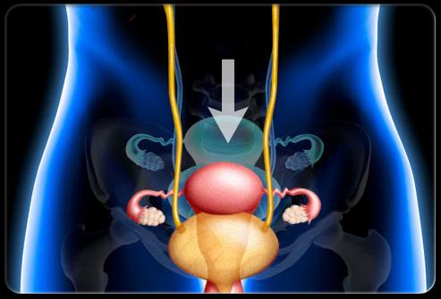 女子右侧下腹部疼痛 经诊断为盆腔脏器脱垂