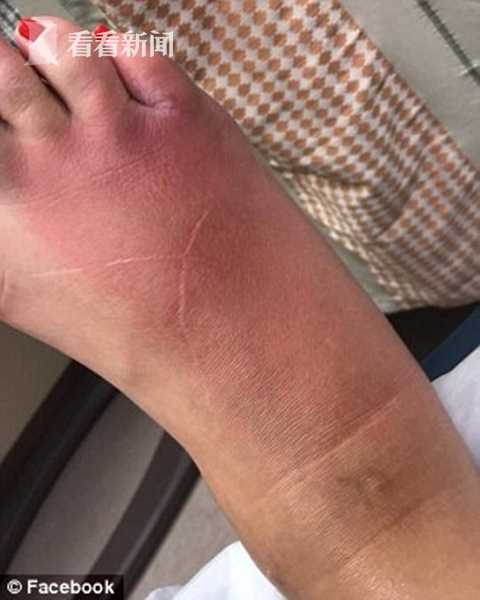 美国女子足疗后脚膨胀发紫一根脚趾险被切除