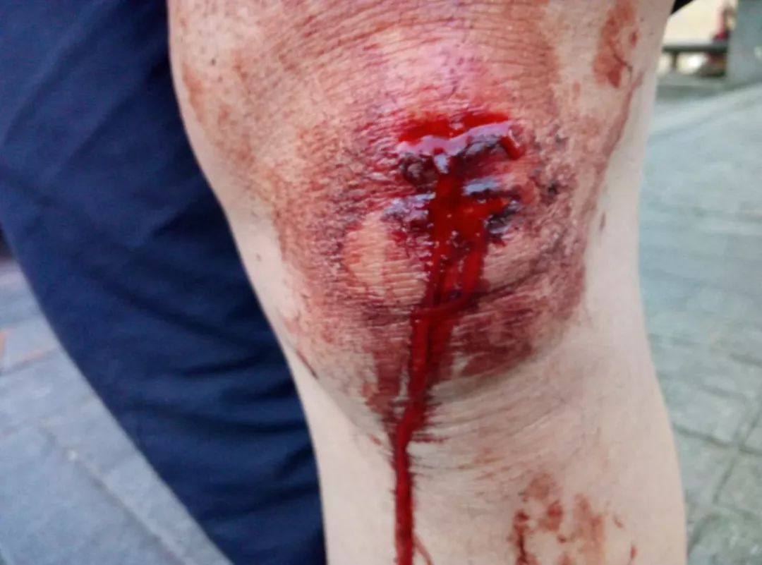 哈尔滨男子打车被拖行百米远多处受伤血流不止伤者悬赏1万寻肇事司机