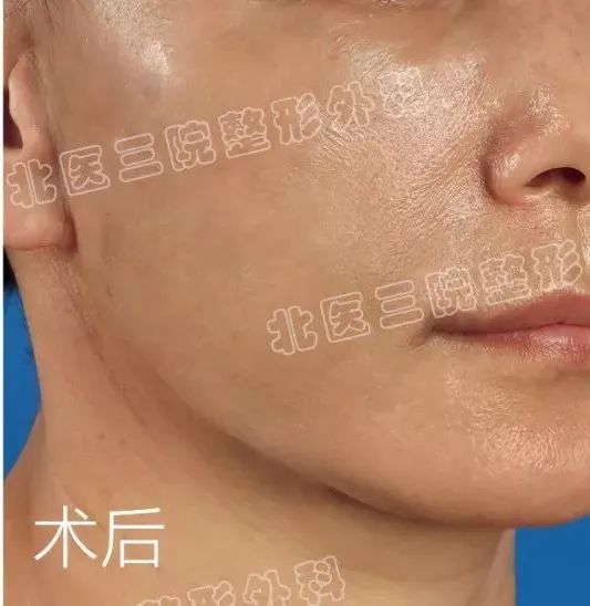 我的"右脸"去哪了?|面部|萎缩|软组织_新浪女性_新浪网