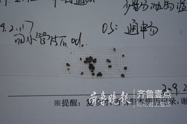 泪道取出50多颗结石!这种眼病症状与结膜炎相似