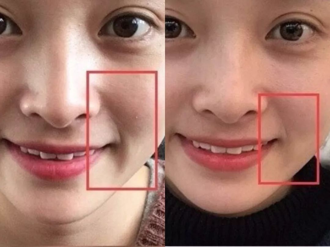 使用后法令纹明显变淡使用后泪沟改善很多使用后下颌线变清晰很多这是