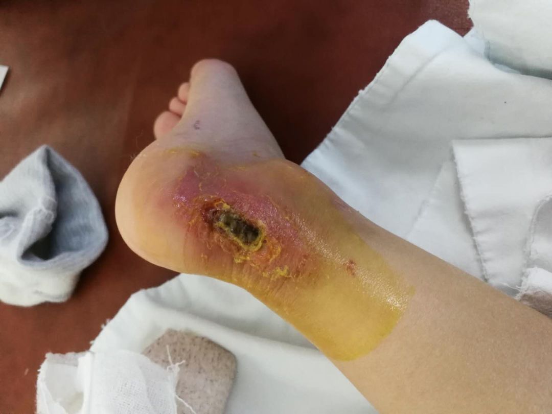破伤风,随后用酒精棉一遍一遍拨开他脚腕上的伤口……中间有一块顽固