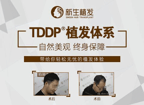 全国好的植发医院排名--上海新生植发医院