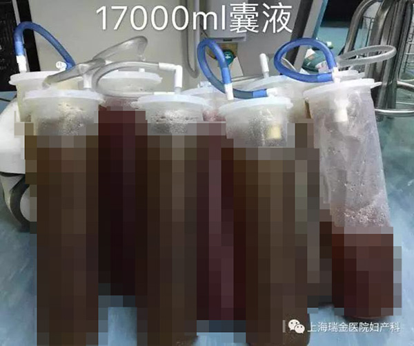 孕相十足?女子腹部藏巨大囊肿,术后抽出34瓶