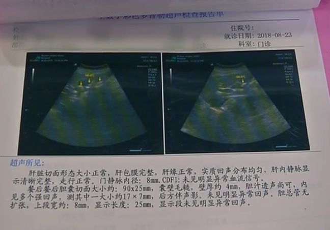"当时通过彩超发现她胆囊里面都是结石,但没想到这么多.