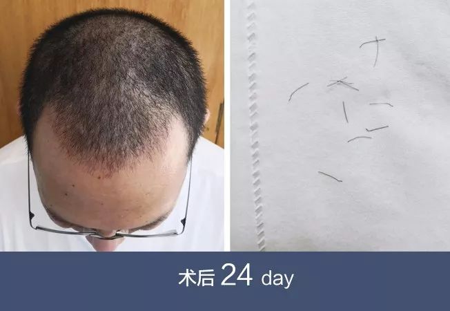 植发医生自己的植发经历分享下
