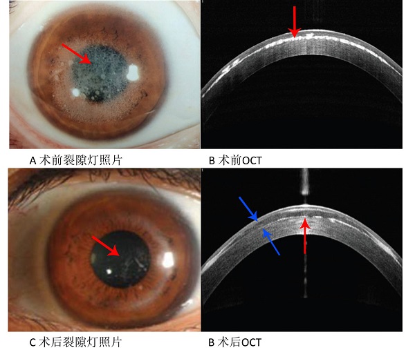 废透镜再创新利用申城医院为角膜病患者重获光明