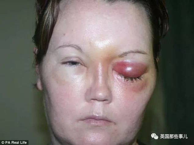 戴隐形眼镜洗了个澡,当晚就什么也看不到了.隐形使用不当,很危险