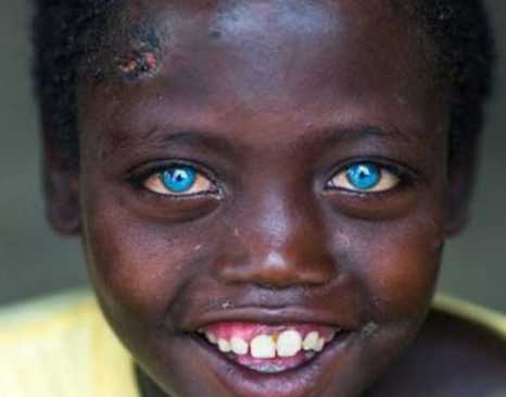 埃塞俄比亚男孩患罕见病症,天生蓝眼睛似混血