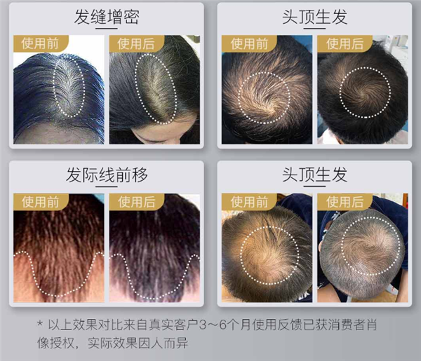 北京友谊医院临床报告验证: 809%的脱发患者生发治疗效果明显