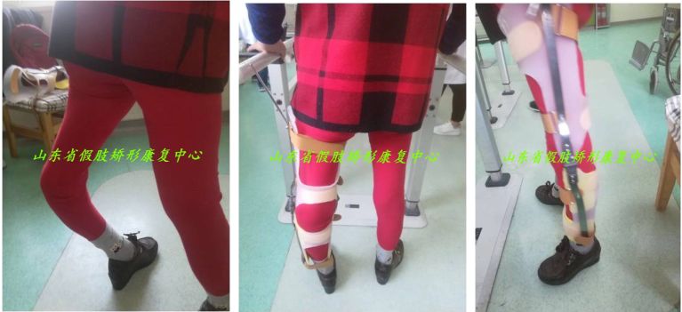 矫形器帮助"儿麻"后遗症患者摆脱尴尬境地!