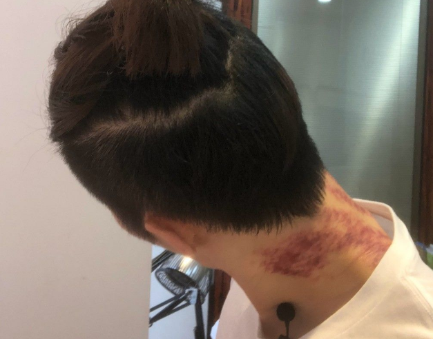 刮痧并非越用力越好 小心伤到肾功能