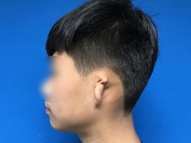 全国征集贫困耳缺损无耳或小耳患者还有14个名额免费修耳朵