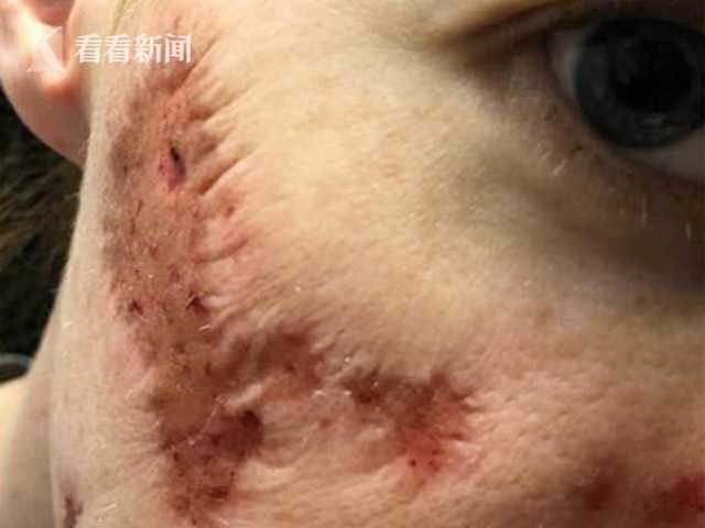 女子公厕用皂液洗手,脸部竟腐烂现坑洞!