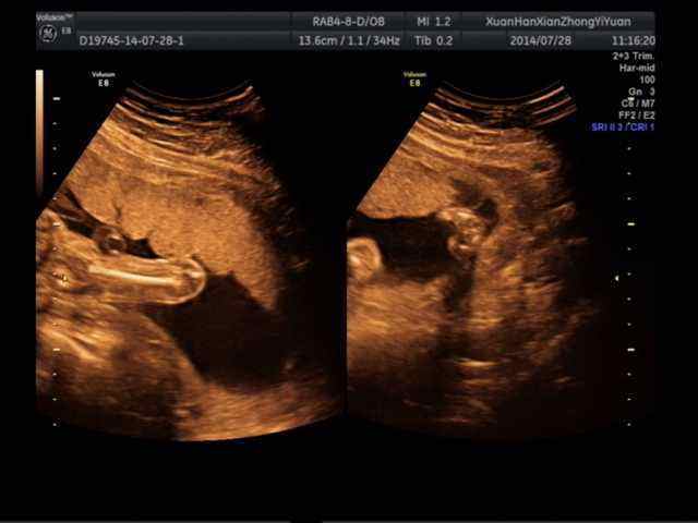 四维彩超:是能够显示没有出生宝宝的实时动态的图像,也可以看清楚胎儿