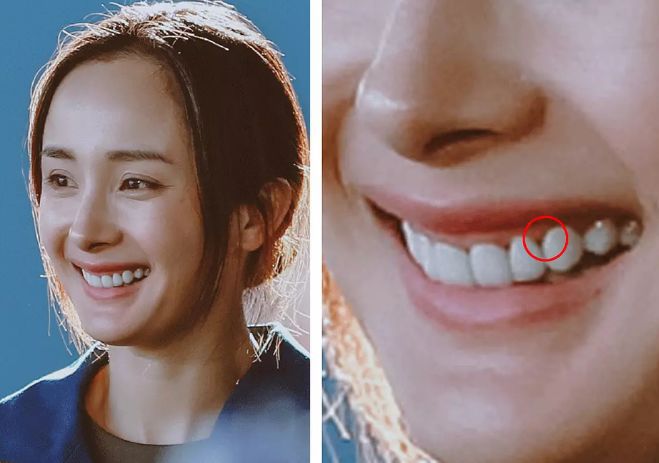 再看看杨幂整了以后的牙,特别是牙齿根部与牙龈交界处,已经明显萎缩出