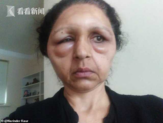 57岁女子使用印度染发剂脸肿成钟楼怪人眼睛挤到消失