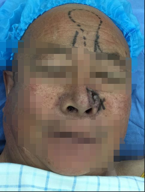 焦点丨男子得癌鼻子被切除四分之一宁夏医生为他重塑