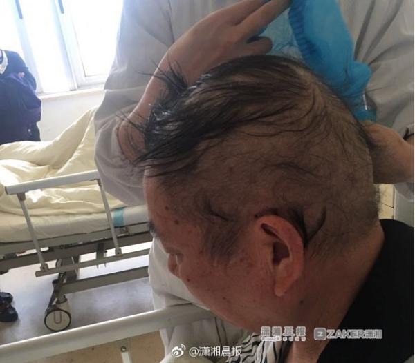 湘潭夫妇同患"怪病"大把掉发,经查系铊中毒超标1400倍